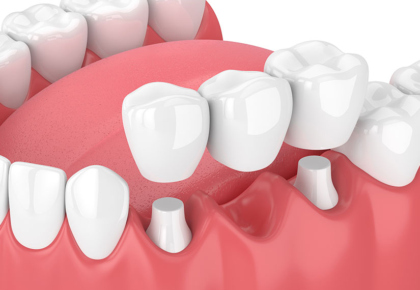 Dental Bridges | Canyon Dental Centre | General & Family Dentist | SE Calgary