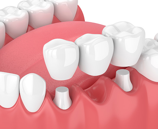 Dental Bridges | Canyon Dental Centre | General & Family Dentist | SE Calgary