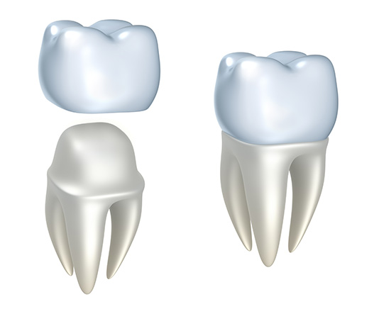 Dental Crowns | Canyon Dental Centre | General & Family Dentist | SE Calgary