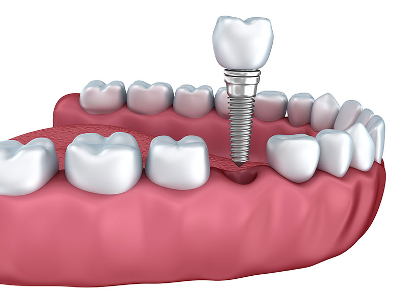 Dental Implants | Canyon Dental Centre | General & Family Dentist | SE Calgary