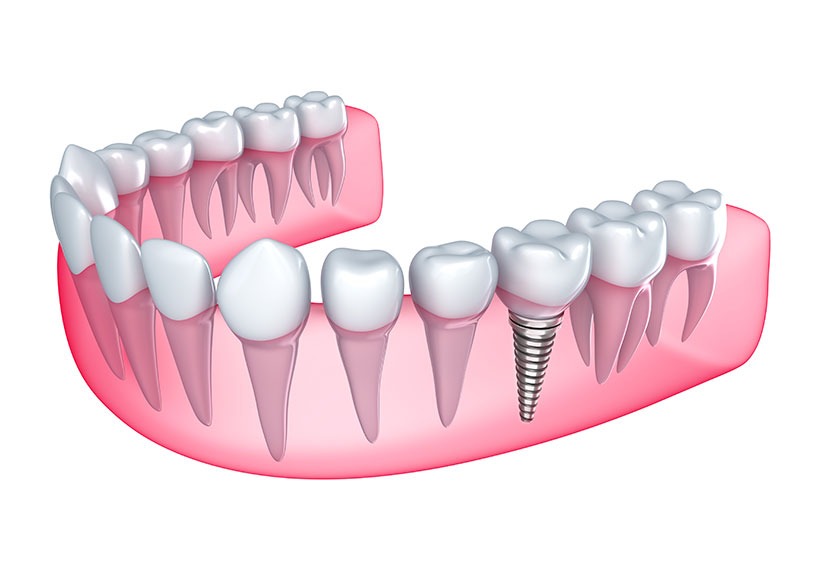 Dental Implants | Canyon Dental Centre | General & Family Dentist | SE Calgary