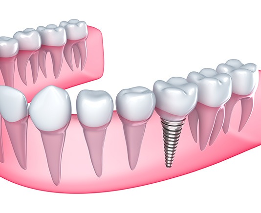 Dental Implants | Canyon Dental Centre | General & Family Dentist | SE Calgary