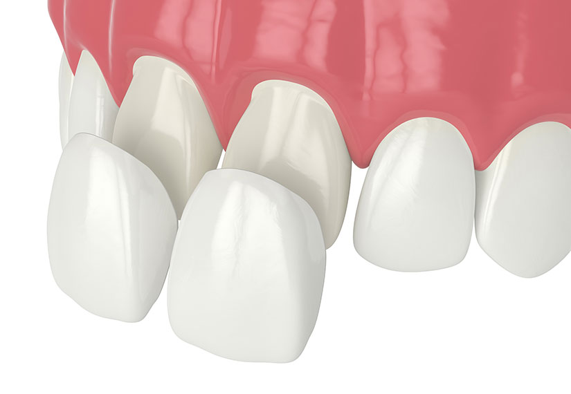 Porcelain Veneers | Canyon Dental Centre | General & Family Dentist | SE Calgary