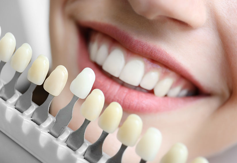 Porcelain Veneers | Canyon Dental Centre | General & Family Dentist | SE Calgary