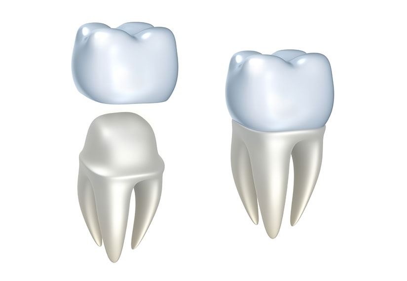 Dental Crowns | Canyon Dental Centre | General & Family Dentist | SE Calgary