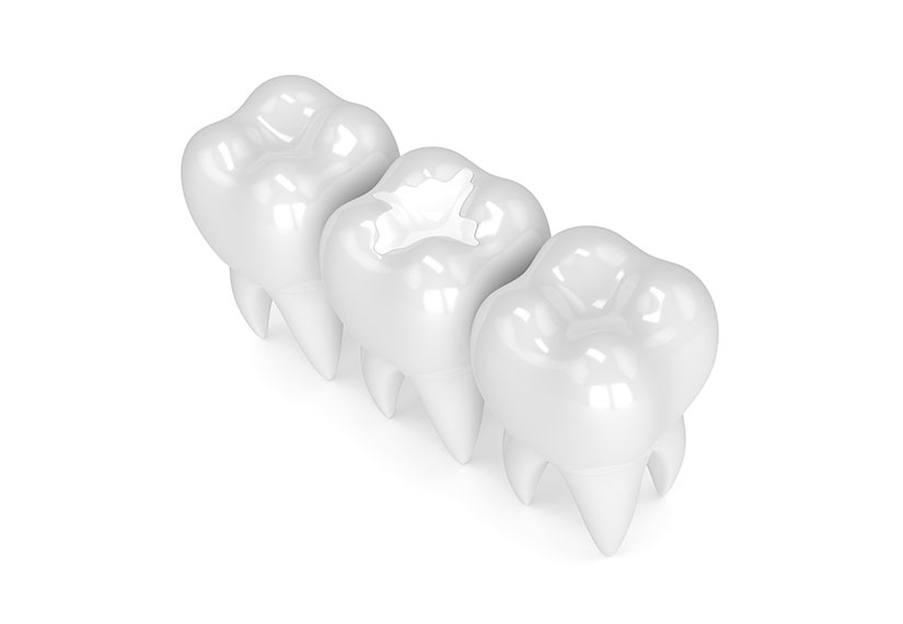 White Fillings | Canyon Dental Centre | General & Family Dentist | SE Calgary