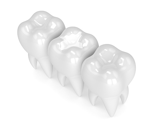 White Fillings | Canyon Dental Centre | General & Family Dentist | SE Calgary