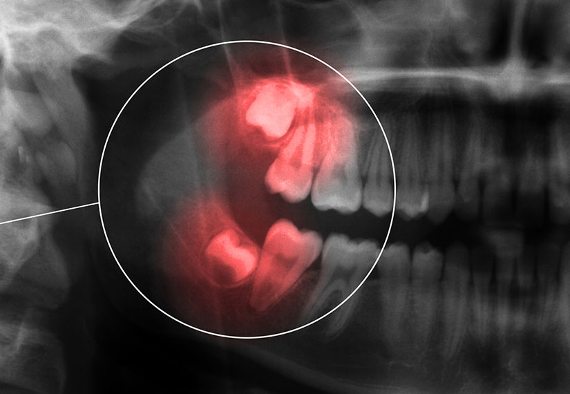 Wisdom Teeth Extractions | Canyon Dental Centre | General & Family Dentist | SE Calgary